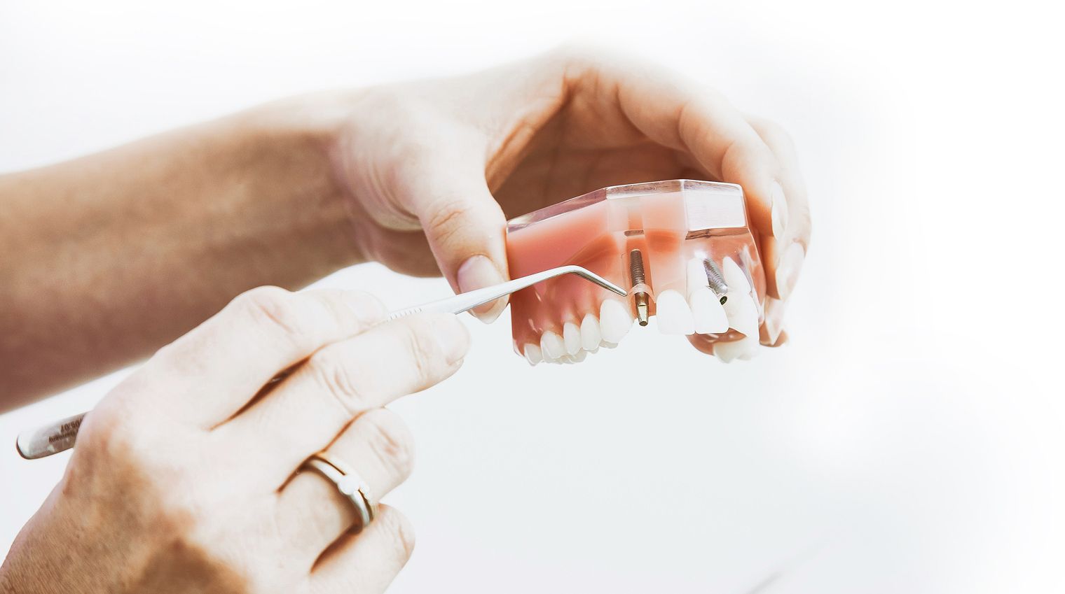 Darstellung eines Zahnimplantats mit einem chirurgischen Instrument.